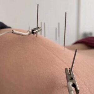 Dry Needling